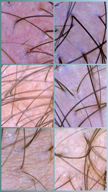 Close-up images of human skin with scattered hair strands and visible pores.