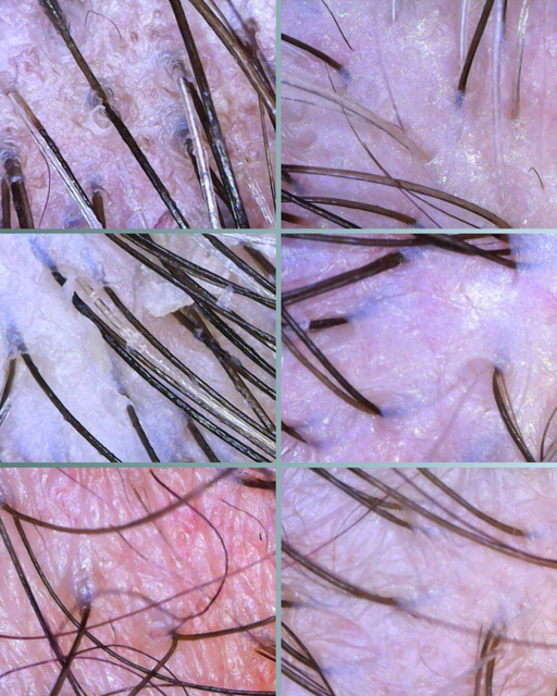 Close-up of human scalp with hair follicles and skin.