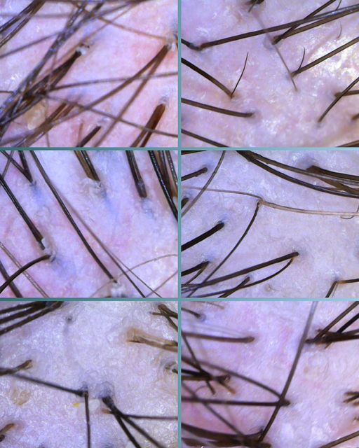 Close-up images of human scalp with hair follicles and hair strands on skin.