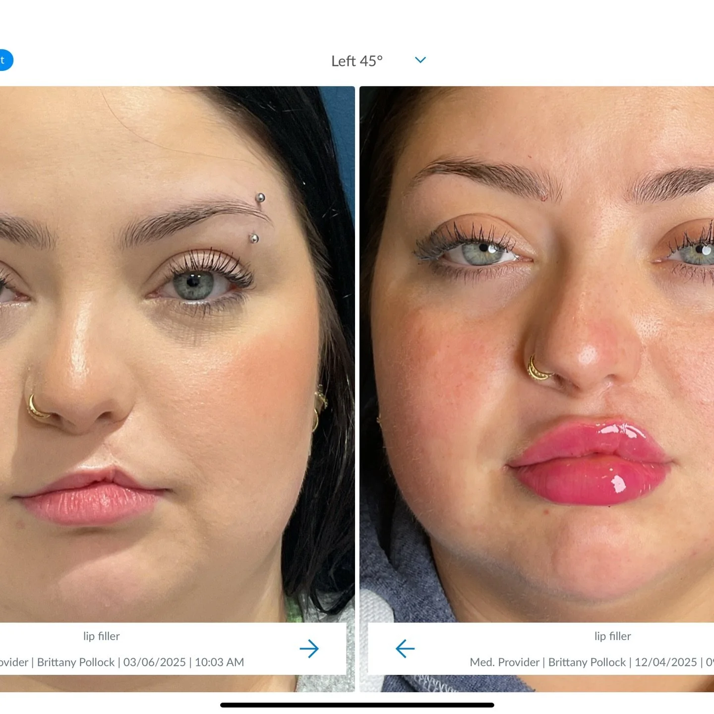 At Toxcology, we&rsquo;re doing more than filling lips&hellip;

We&rsquo;re changing lives, restoring confidence, and helping our clients step into the very best version of themselves. ❤️

This beautiful client has undergone several surgeries through