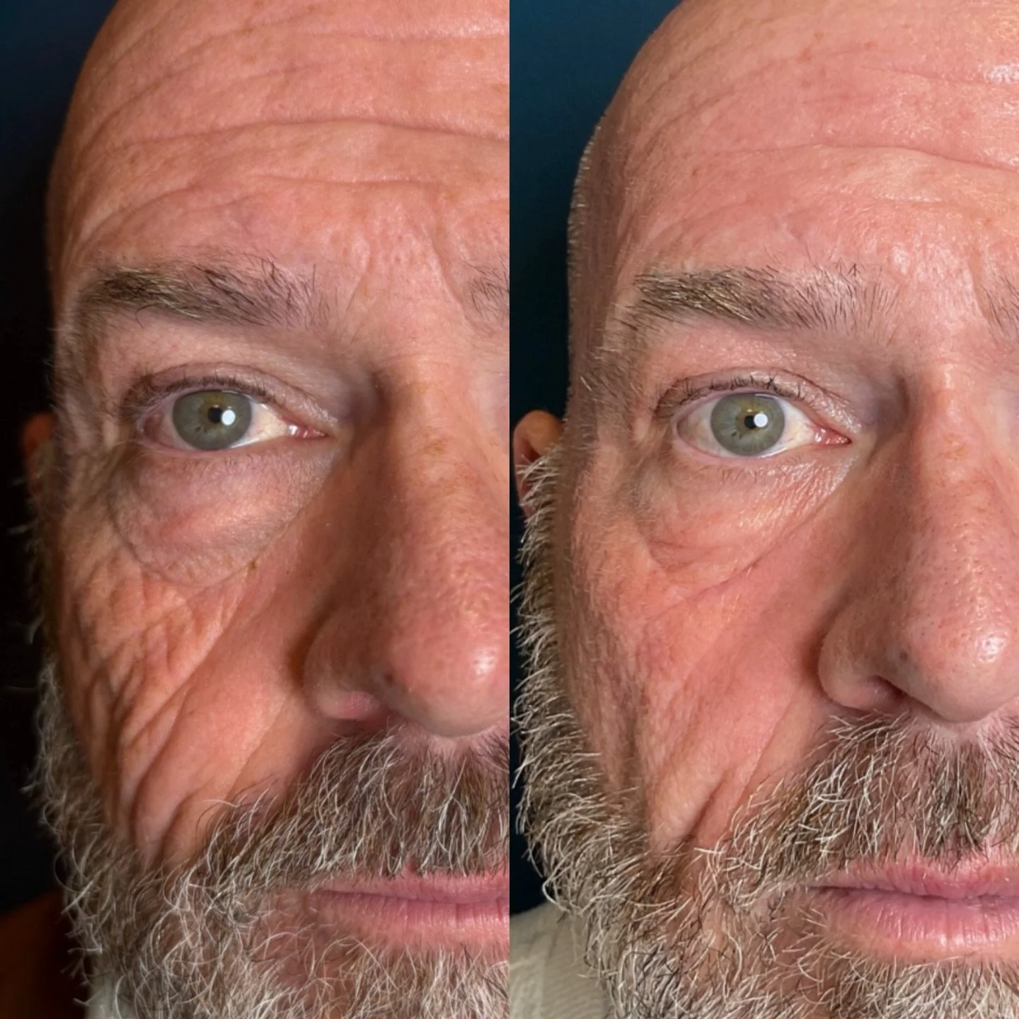 Men Morpheus too 👀 

Aesthetic treatments aren&rsquo;t just for women.
Men have skin too&mdash;and whatever your priority or concern is, we can treat it and recommend a plan that makes sense for you.

What you&rsquo;re seeing here is the result of o