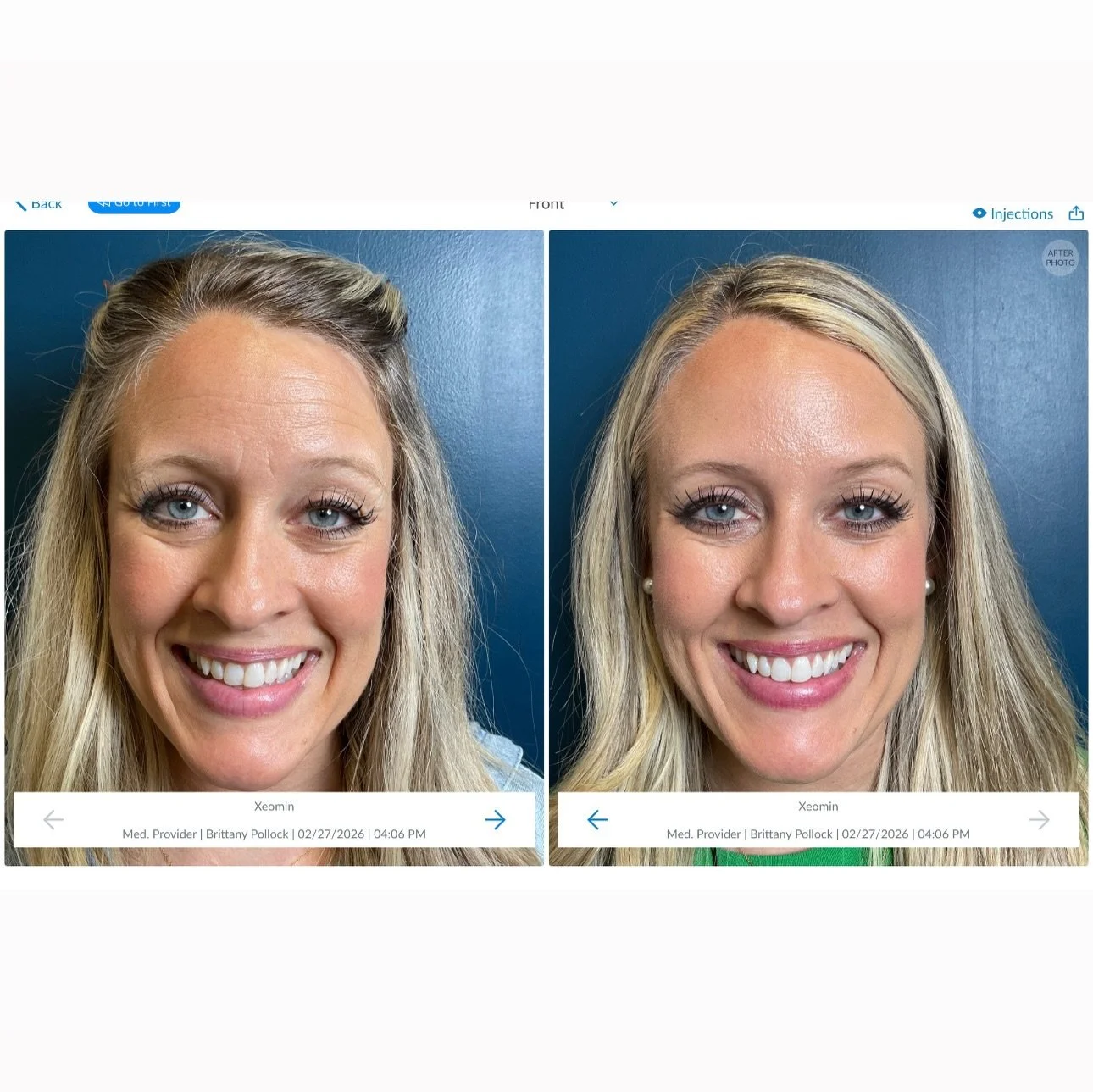 A little tox&hellip; a lot of strategy! 

It&rsquo;s not often I get excited over tox results&hellip;
Not because they aren&rsquo;t good, but because tox is such an everyday treatment.
But sometimes, the artistry really shows.
A few well-placed units