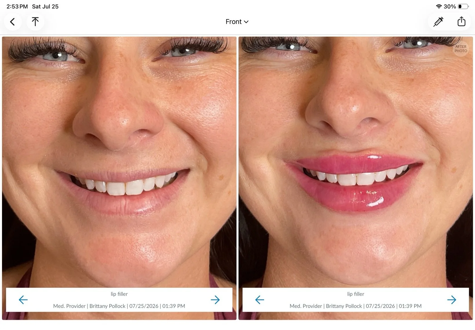 It doesn&rsquo;t have to be third times the charm&hellip; 

2 prior FAILED attempts elsewhere she finally got the results she deserved. 💋 

Book &ldquo;Cupid&rsquo;s Bow&rdquo;

📍Testimony Restorative Aesthetics + Wellness 
1329 Front Ave. suite E
