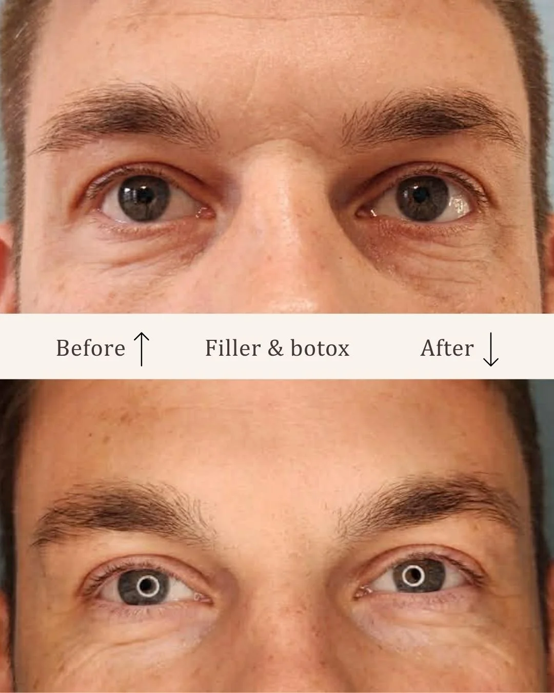Filler-tear-trough-visage-studio-kosmetisk-klinik-odense-2.jpg