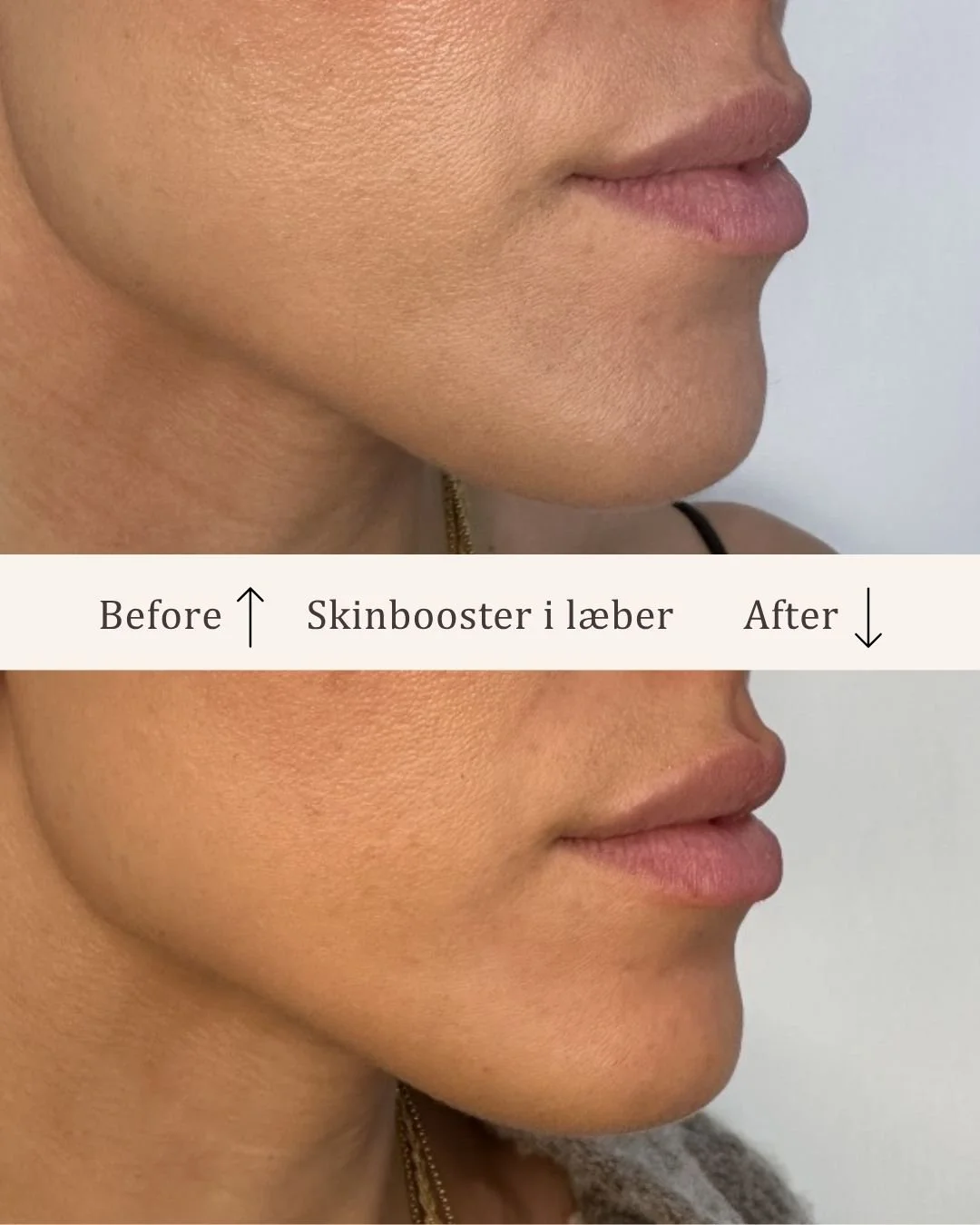 Skinbooster-læber-visage-studio-kosmetisk-klinik-odense-3.jpg
