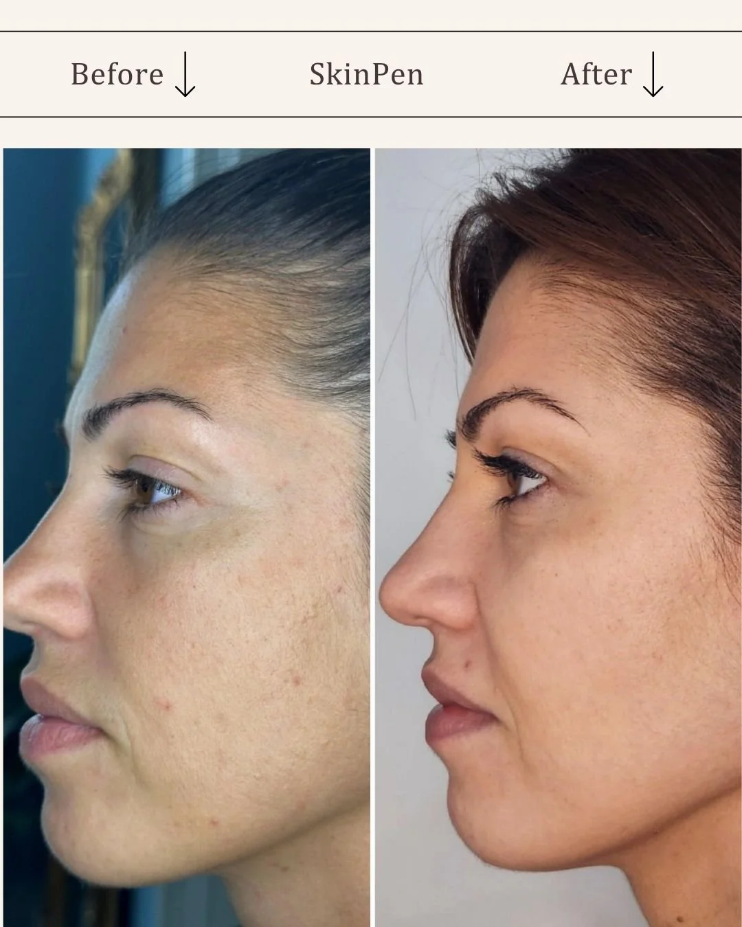 Skinpen-microneedling-visage-studio-kosmetisk-klinik-odense-3.jpg