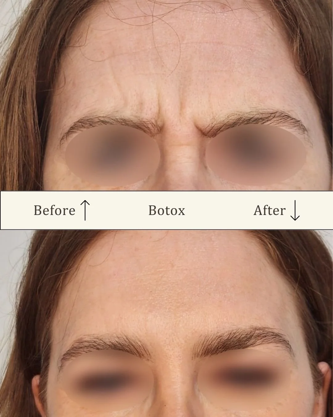 Botox bekymringsrynke 2.jpg