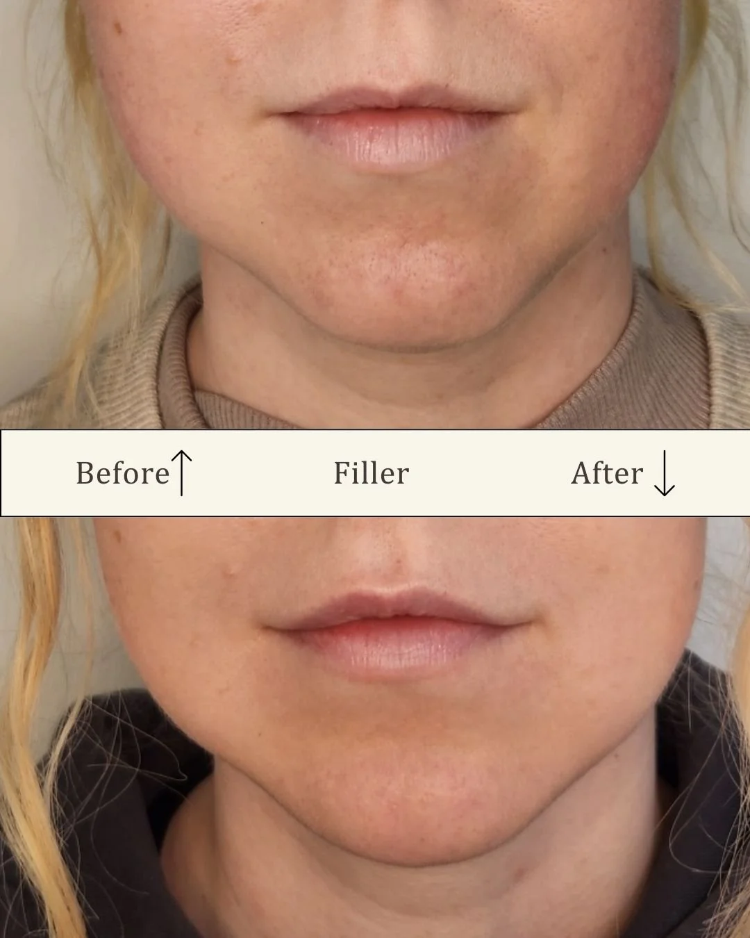 Lipfiller