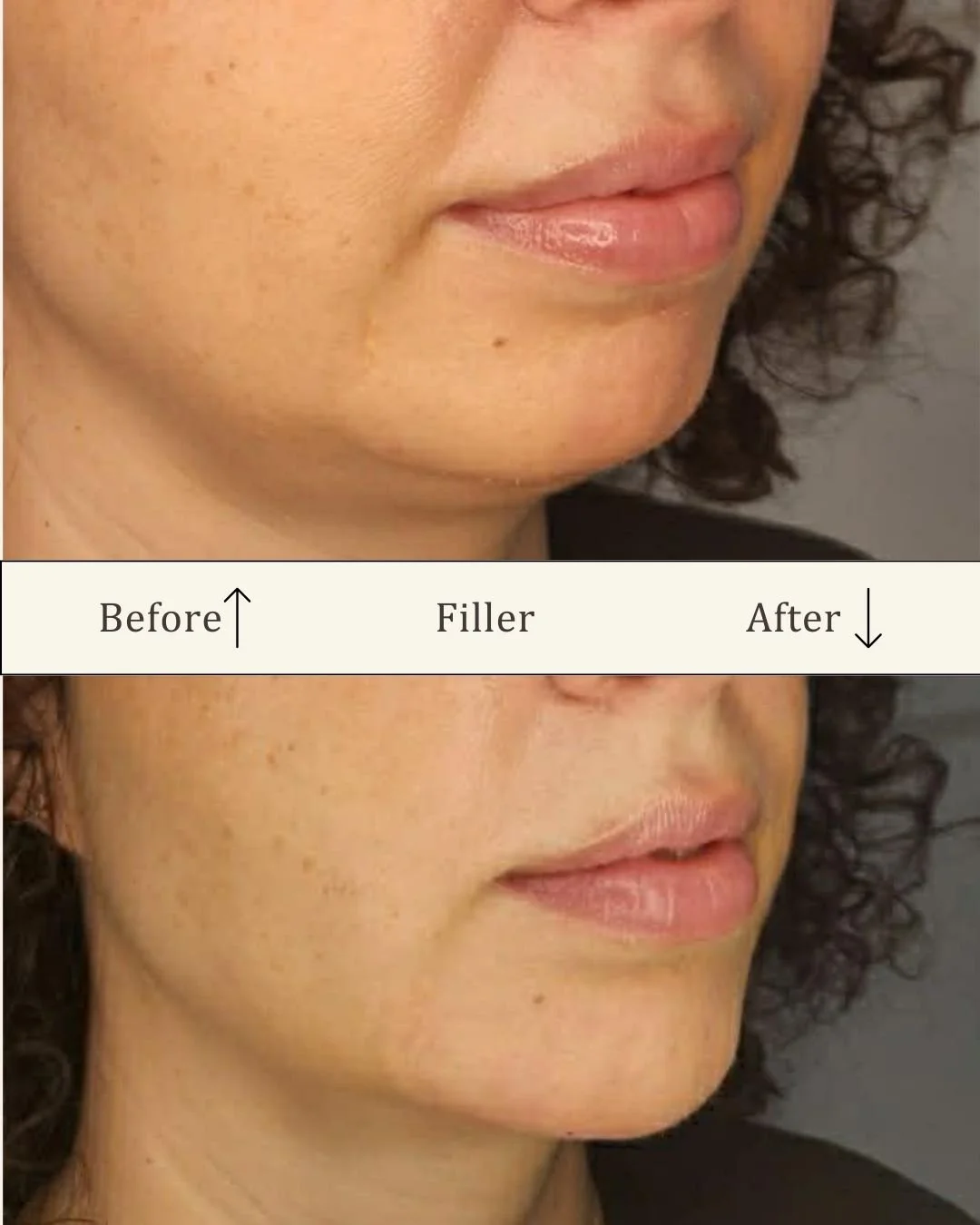 filler-hage-odense-for-efter-profil.jpg