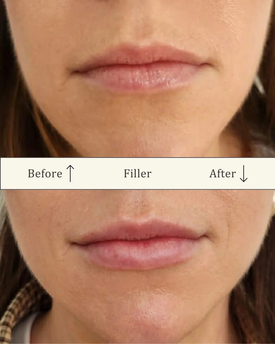 Lipfiller