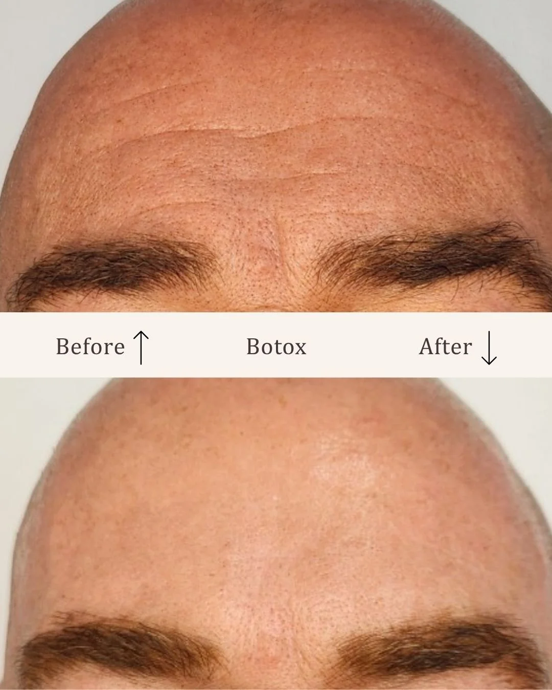 Botox-pande-visage-studio-kosmetisk-klinik-odense.jpg