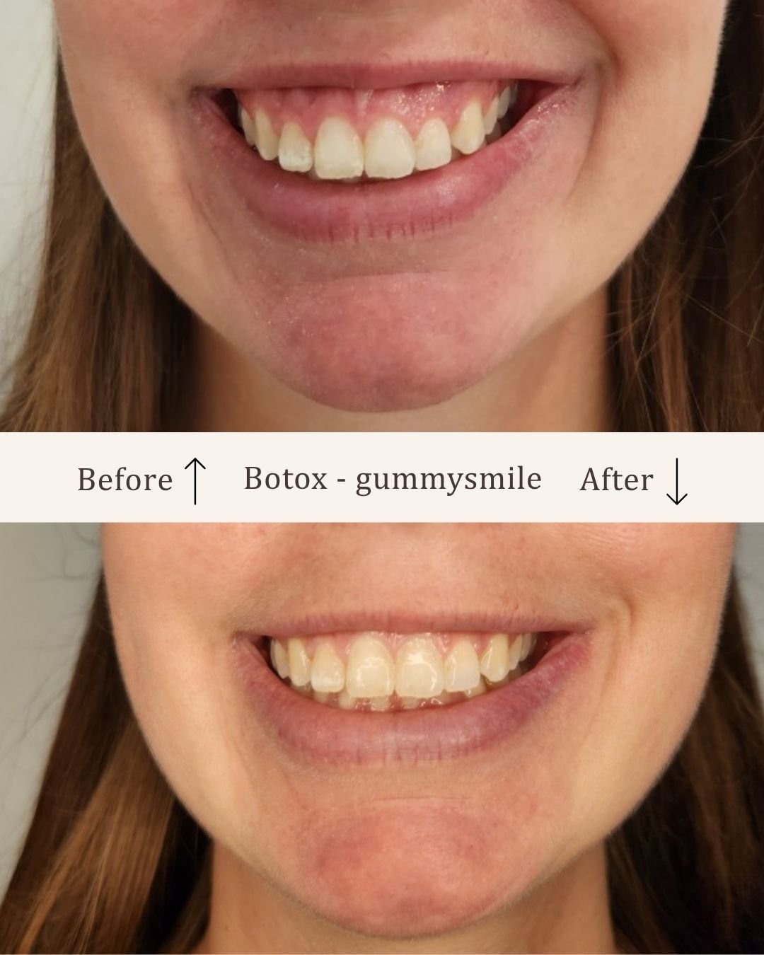 Botox-gummysmile-visage-studio-kosmetisk-klinik-odense.jpg
