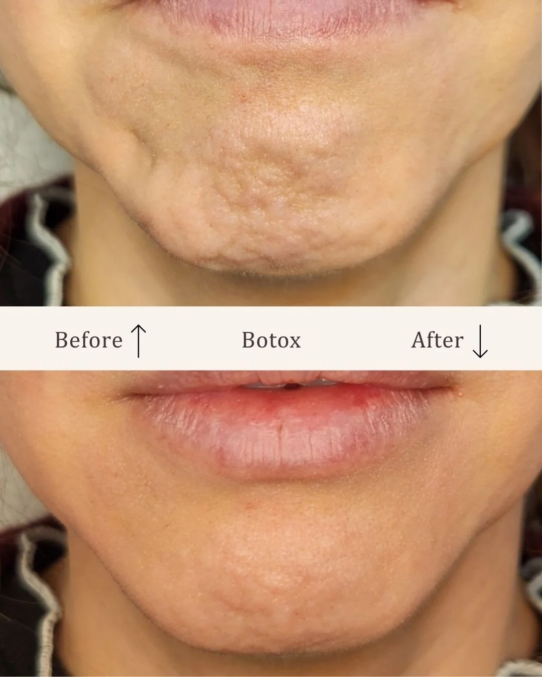 Botox-hage-kombination-visage-studio-kosmetisk-klinik-odense.jpg