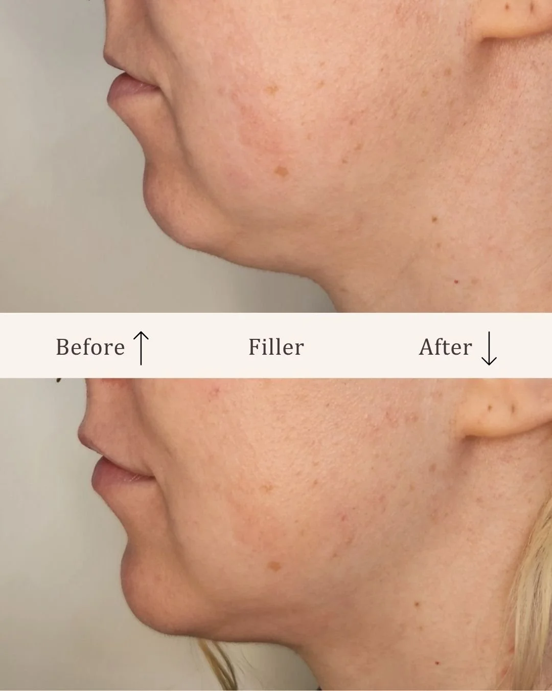 Filler-hage-visage-studio-kosmetisk-klinik-odense-3.jpg