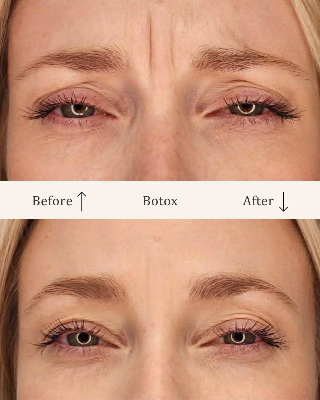 Botox-glabella-visage-studio-kosmetisk-klinik-odense-2.jpg