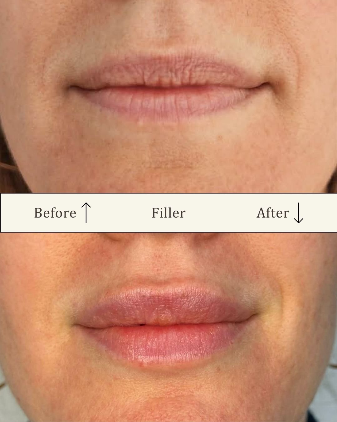 Før- og efterbillede af lip filler med øget volumen og mere definerede læber hos Visage Studio i Odense C