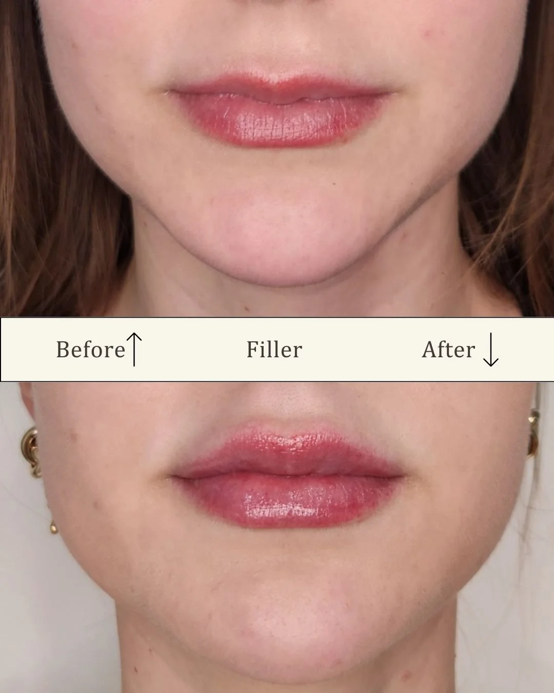 Lipfiller