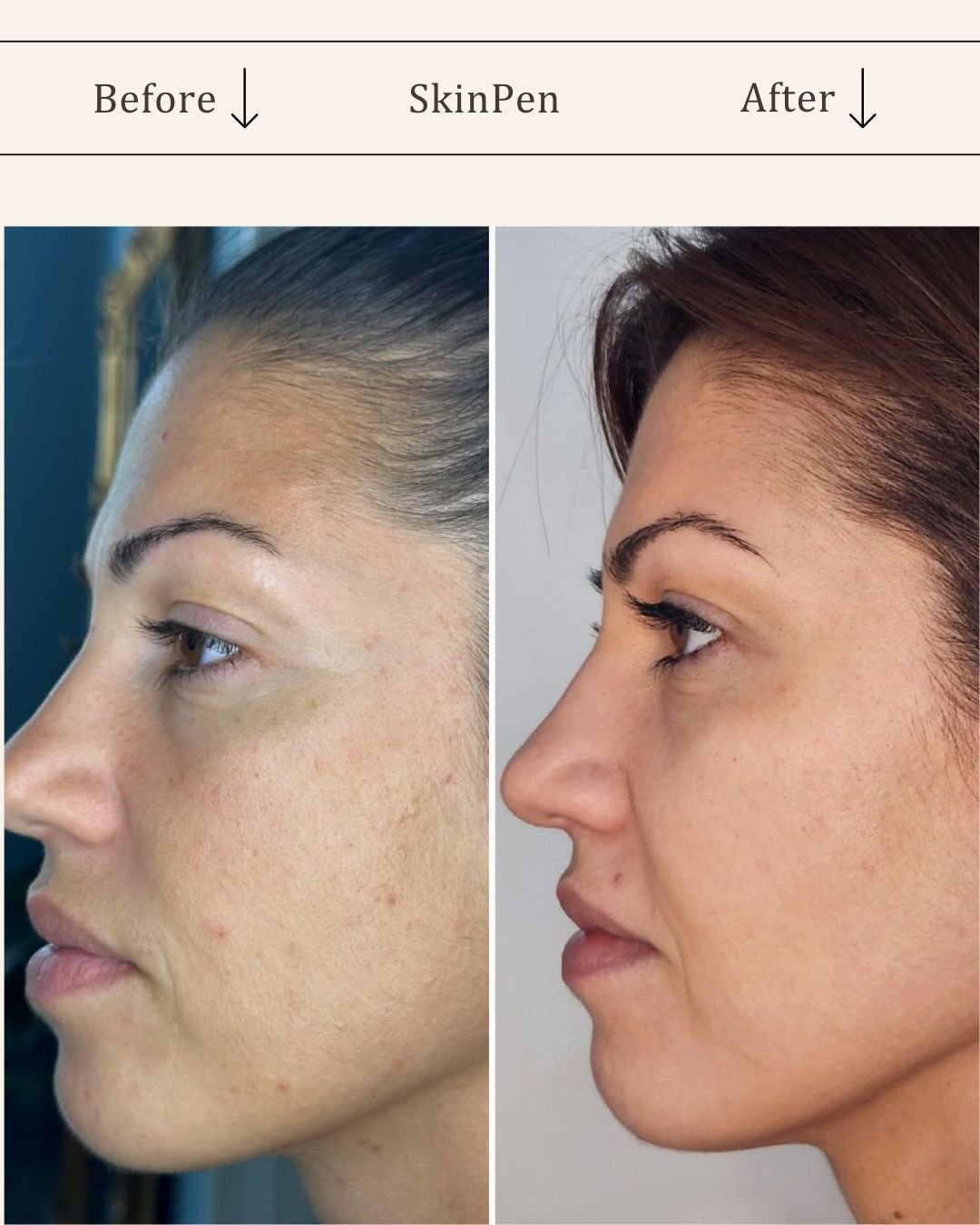 Skinpen-microneedling-foer-efter-odense-visage-studio.jpg