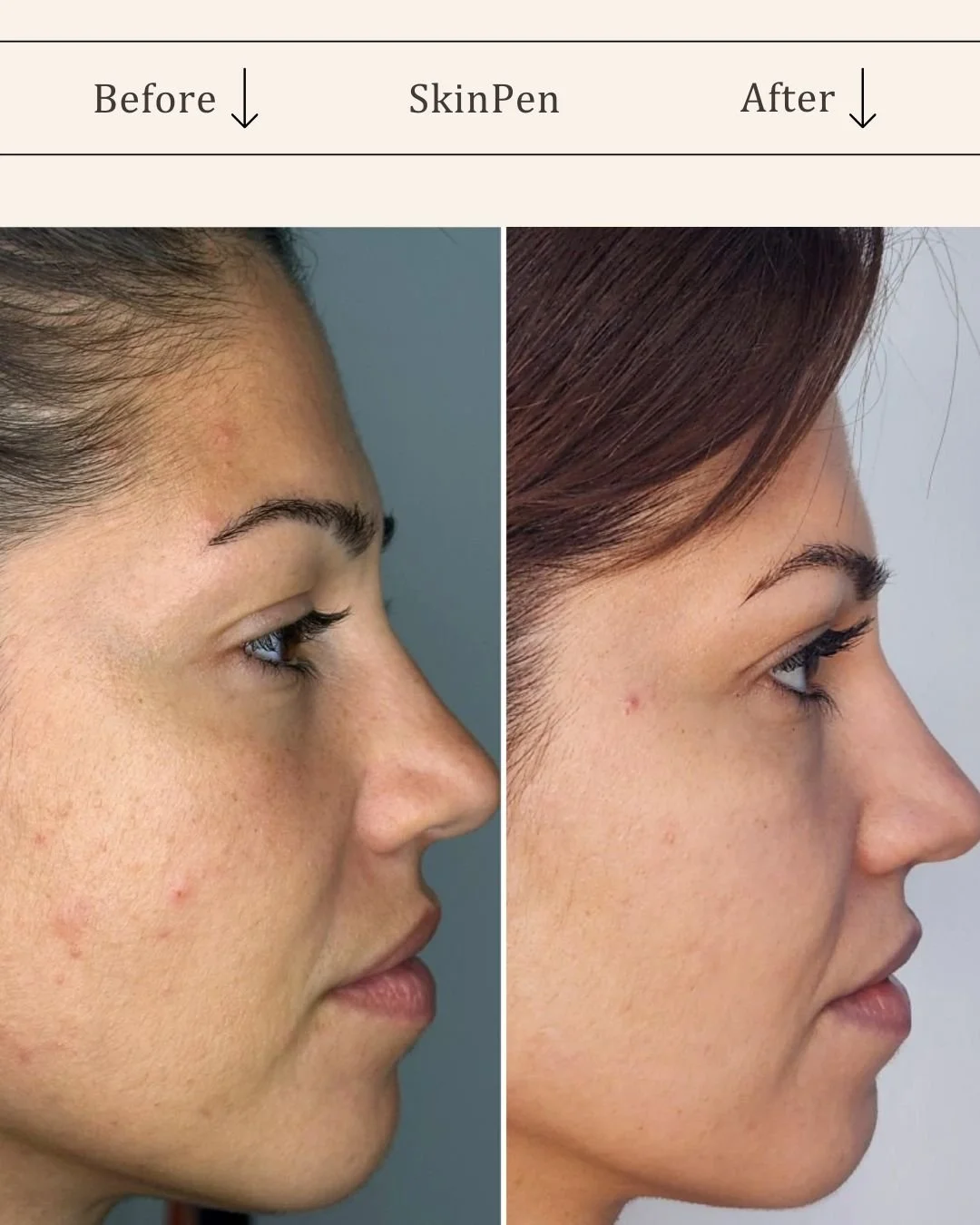 Skinpen-microneedling-foer-efter-odense-visage-studio.jpg