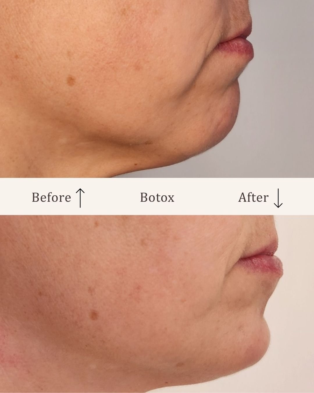 Botox-mundvige-visage-studio-kosmetisk-klinik-odense-4.jpg