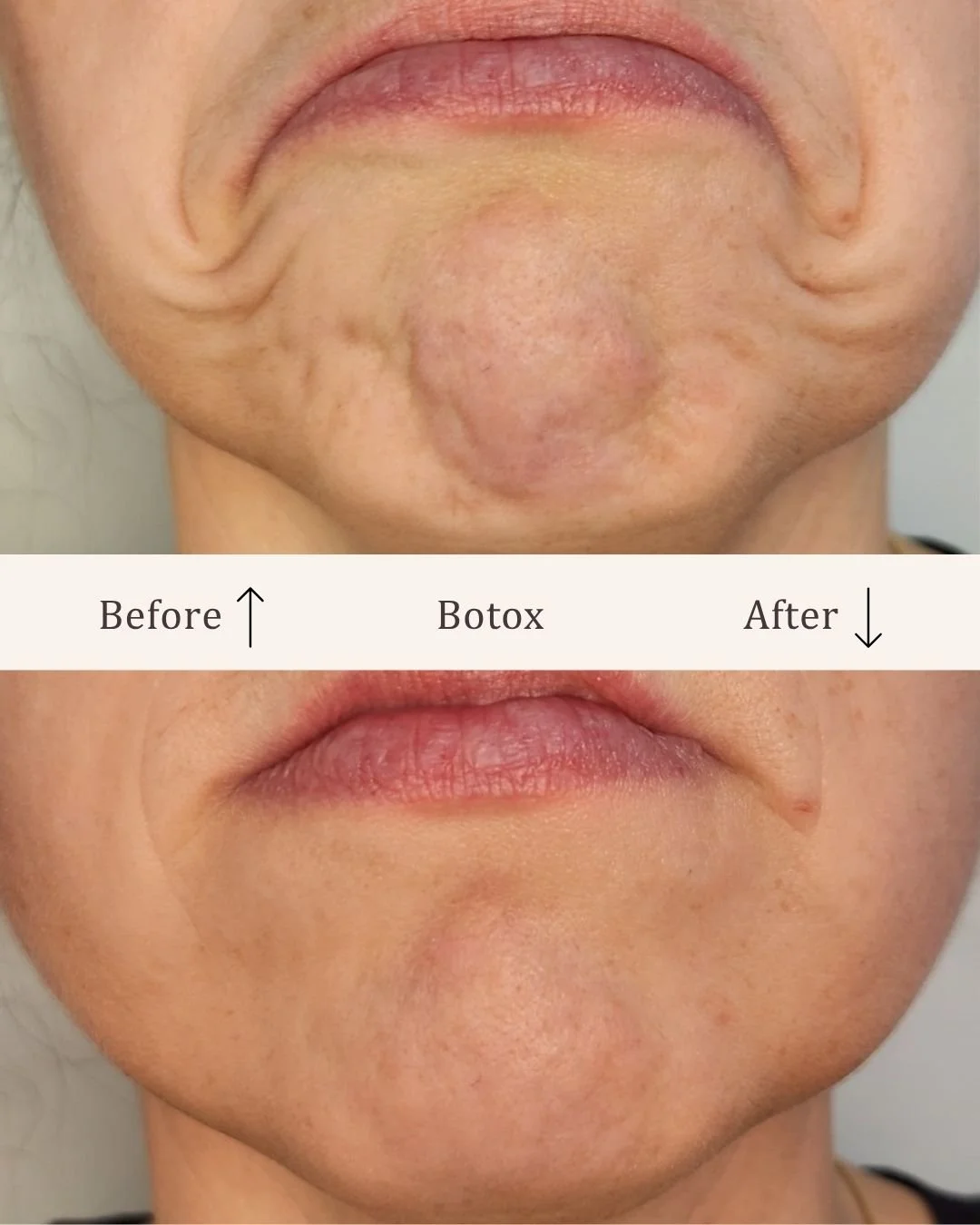 Botox-mundvige-visage-studio-kosmetisk-klinik-odense.jpg