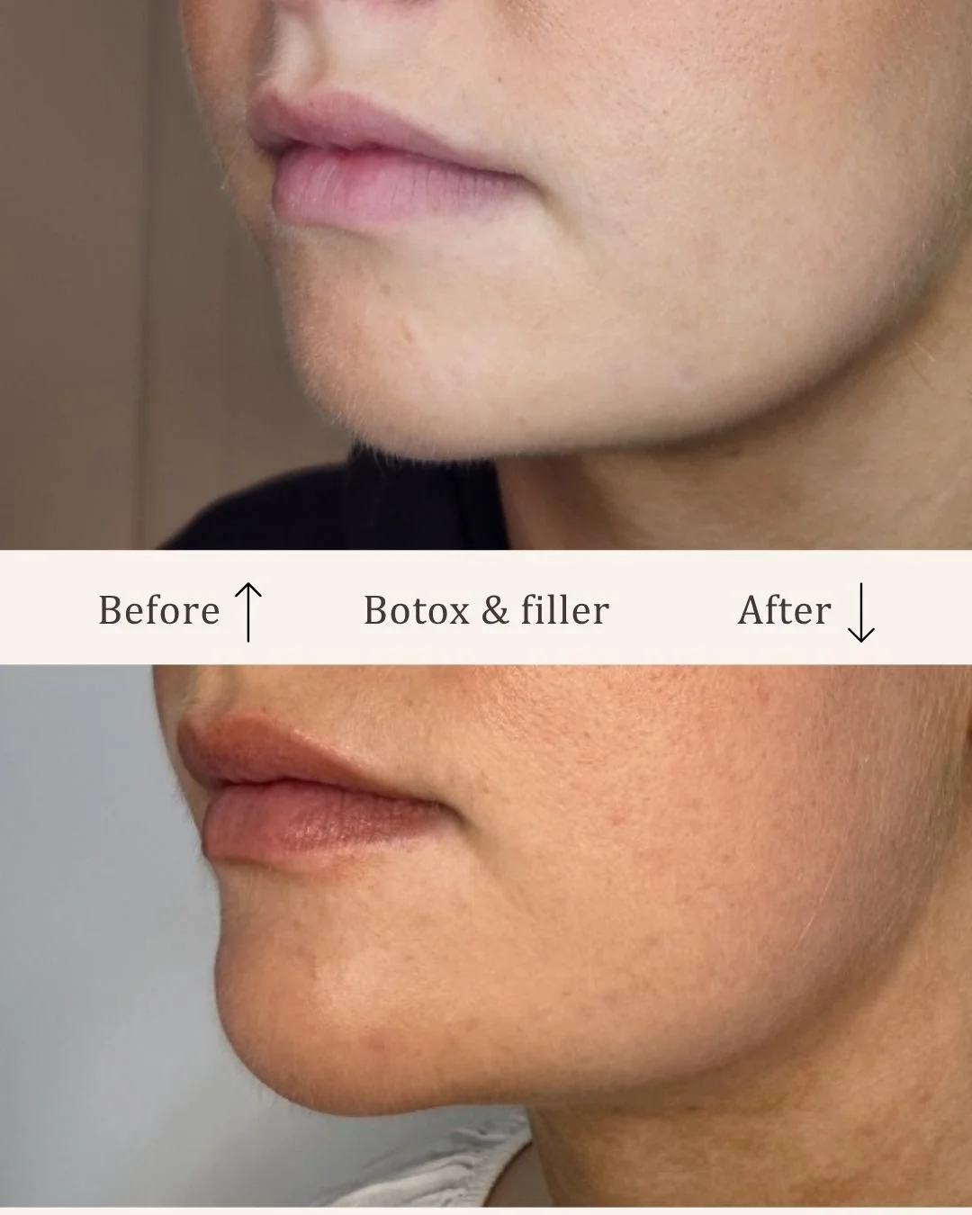 Botox-filler-kombination-visage-studio-kosmetisk-klinik-odense-7.jpg