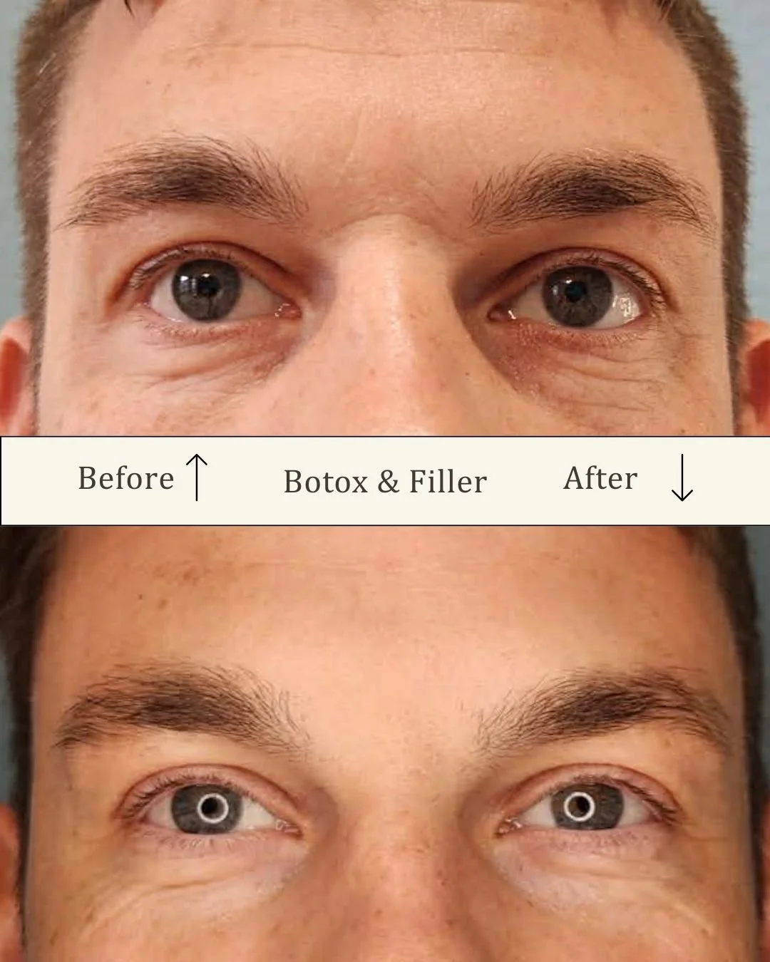 Filler under øjnene - tear trough