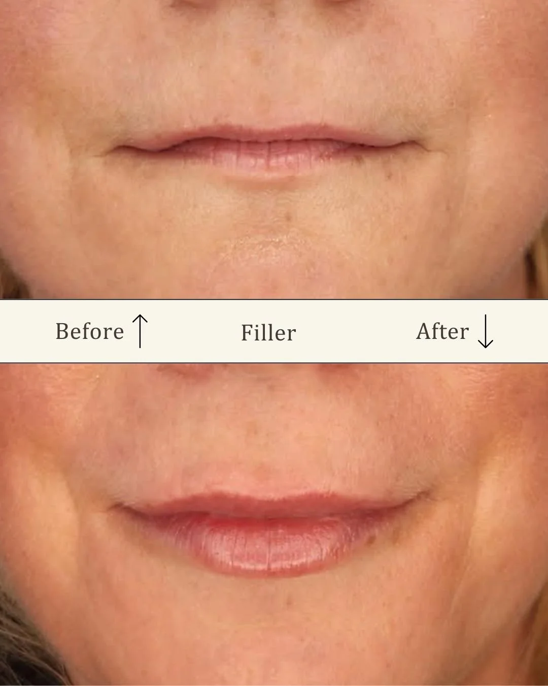 Lipfiller