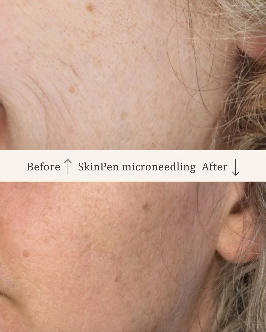 Skinpen-microneedling-visage-studio-kosmetisk-klinik-odense-2.jpg