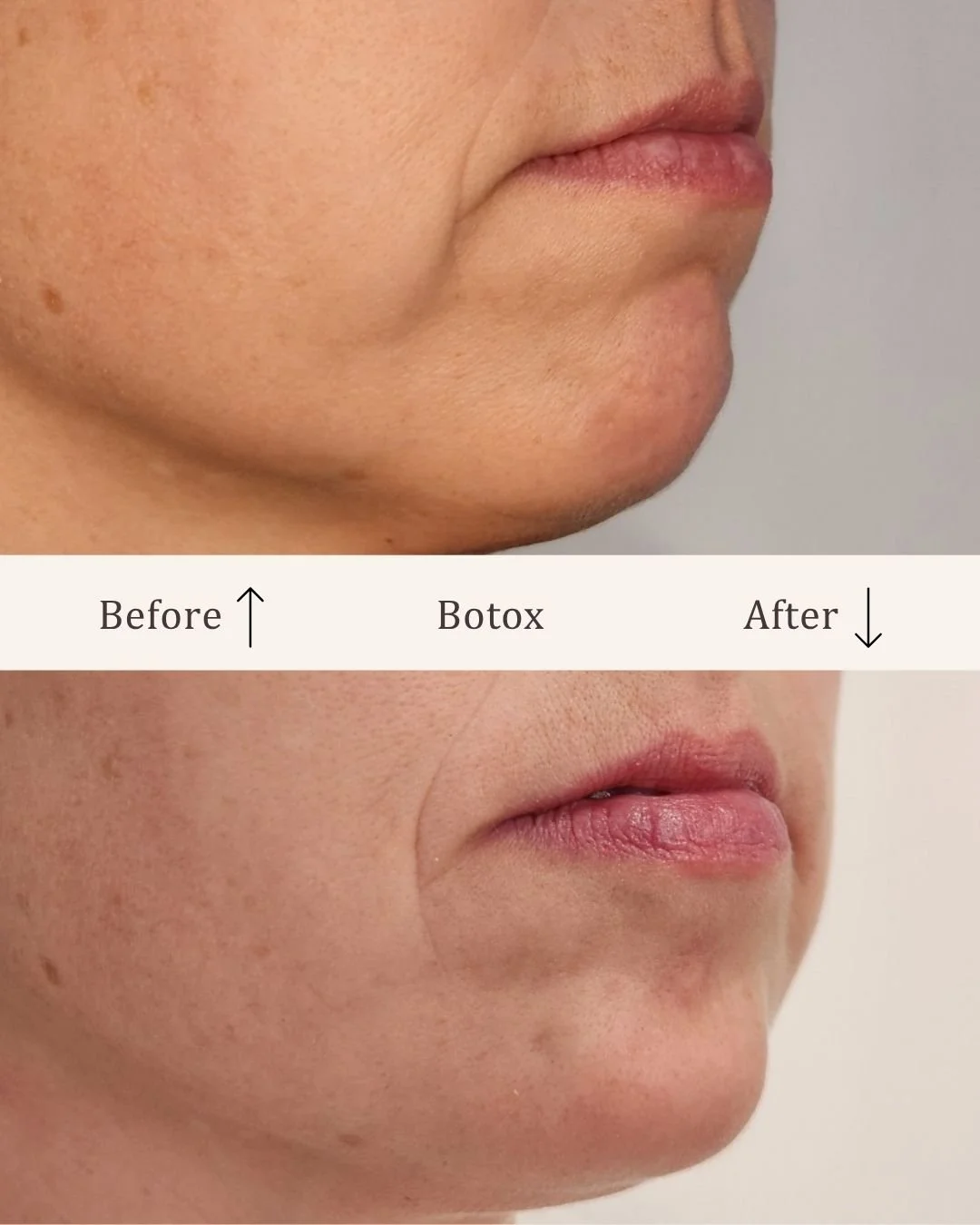 Botox-mundvige-visage-studio-kosmetisk-klinik-odense-3.jpg