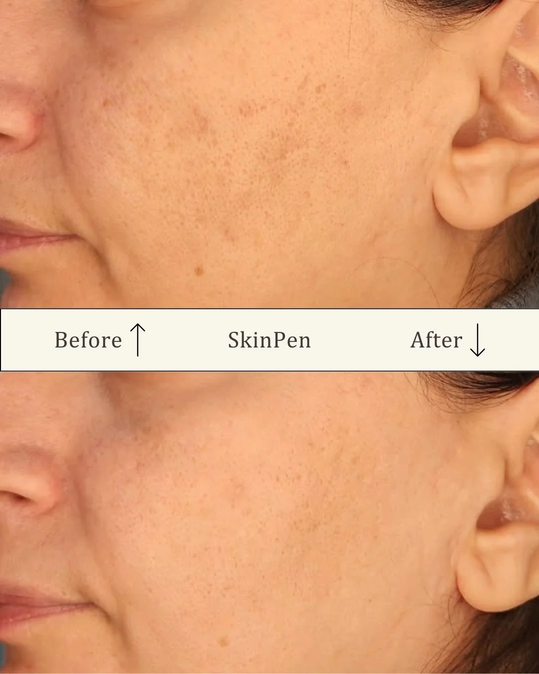 skinpen-microneedling-foer-efter-odense.jpg