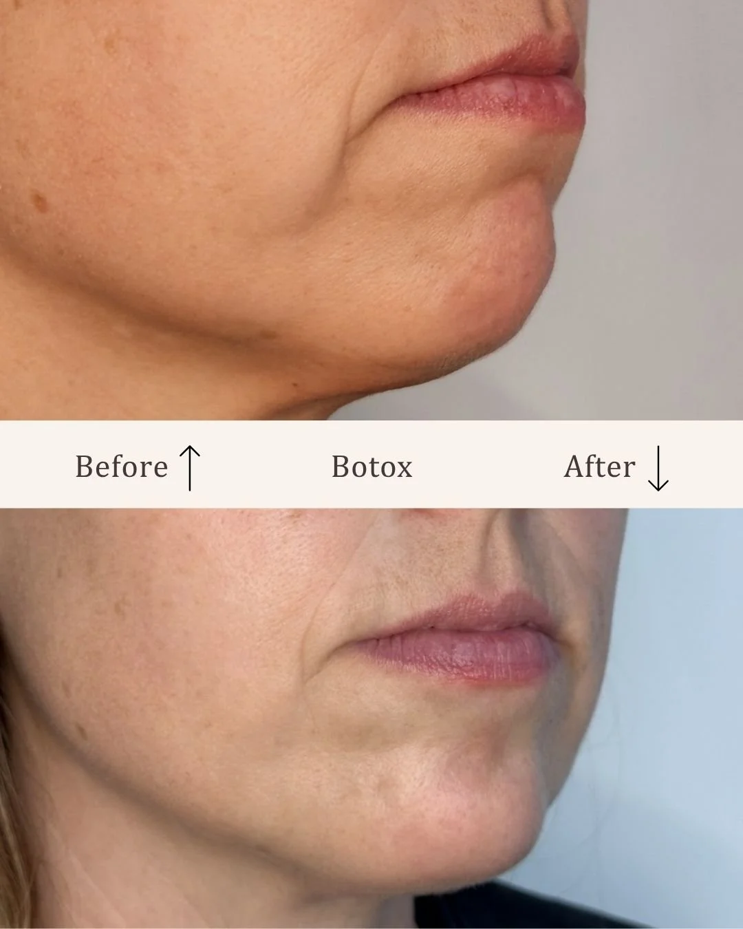 Botox-hage-visage-studio-kosmetisk-klinik-odense (2).jpg