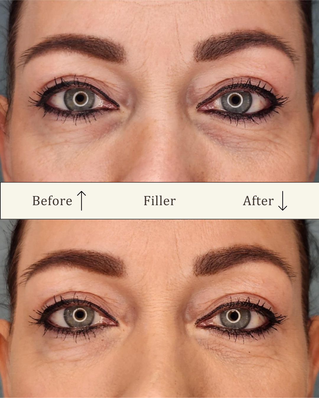 Filler under øjnene - tear trough