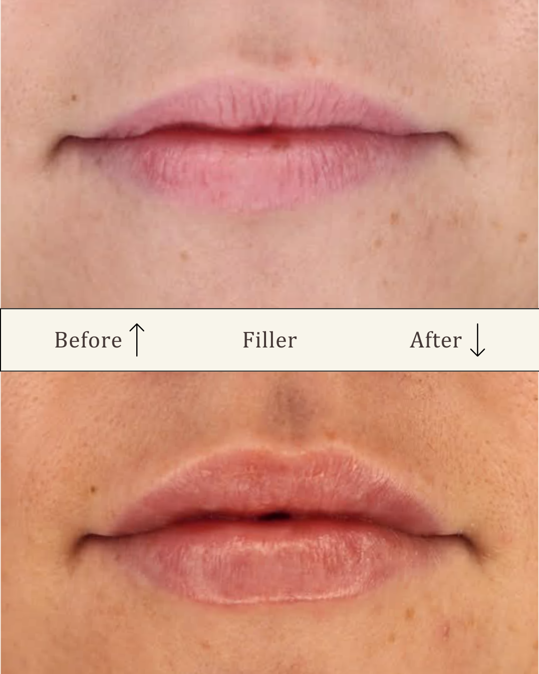 Lipfiller