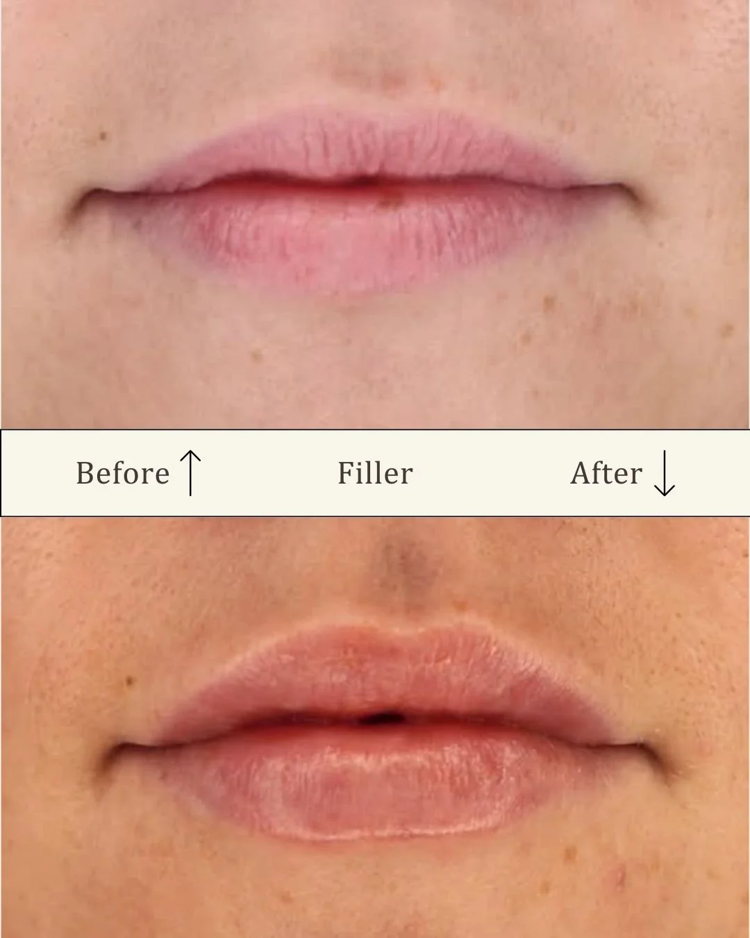 Lipfiller