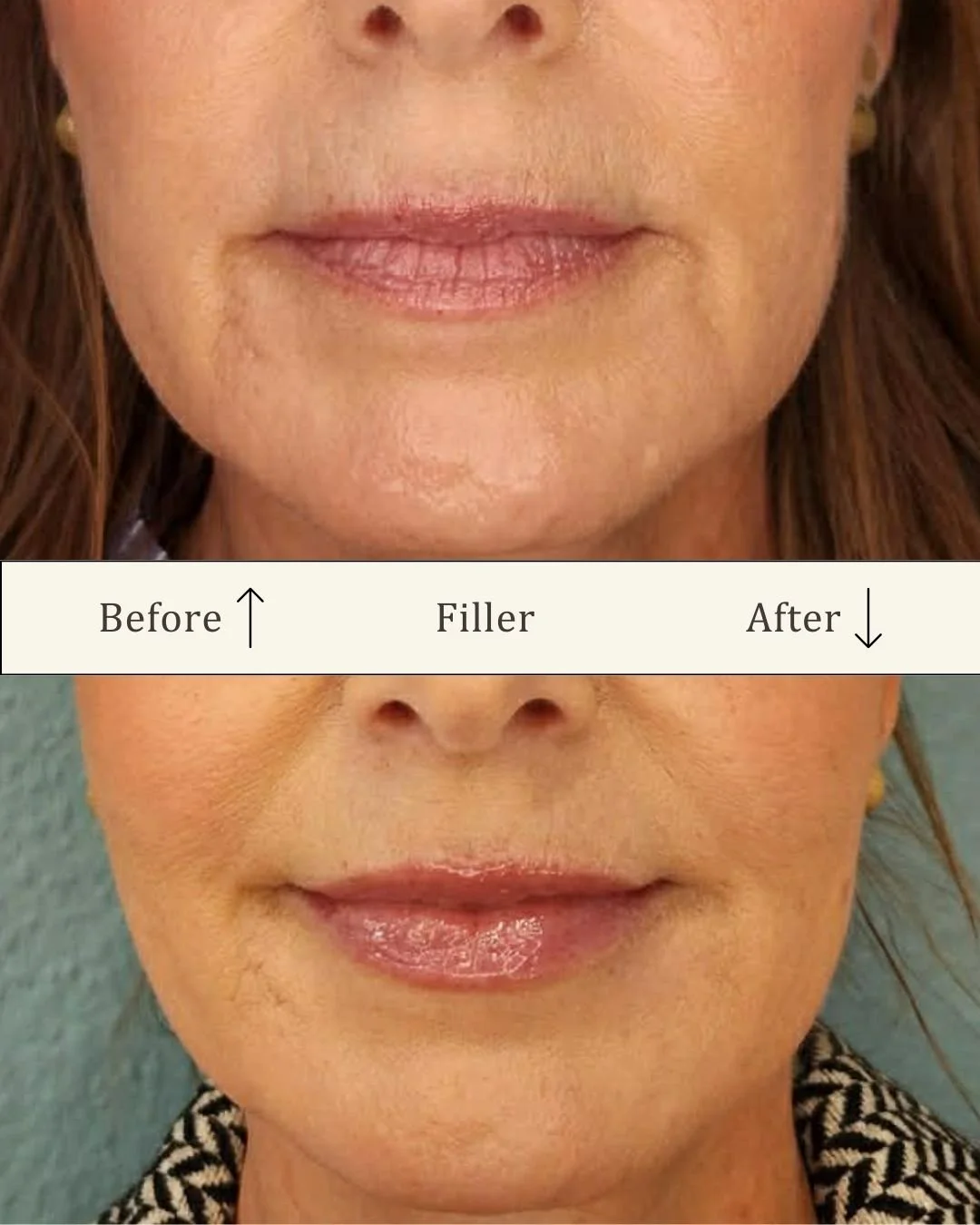 filler-laeber-odense-for-efter-visage-studio.jpg