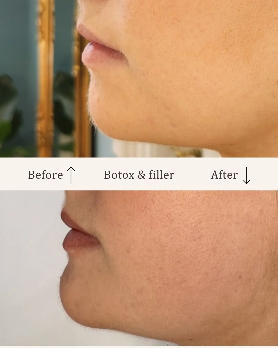 Botox-filler-kombination-visage-studio-kosmetisk-klinik-odense-4.jpg