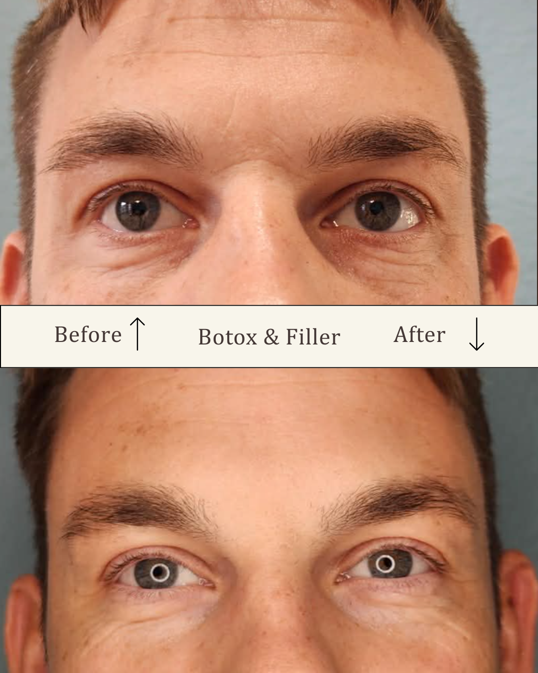 Filler under øjnene - tear trough