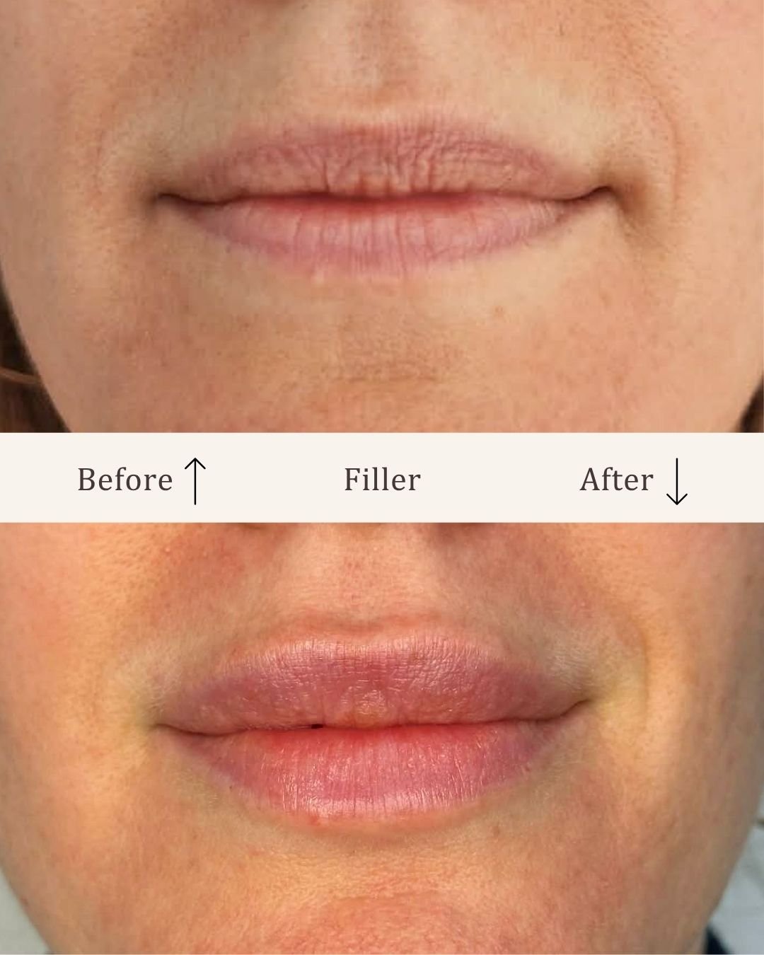 Filler-lipfiller-visage-studio-kosmetisk-klinik-odense-13.jpg