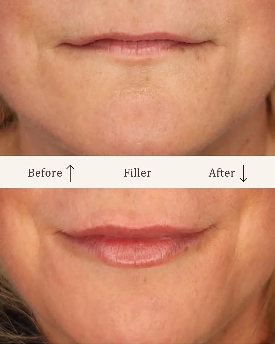 Filler-lipfiller-visage-studio-kosmetisk-klinik-odense-21.jpg