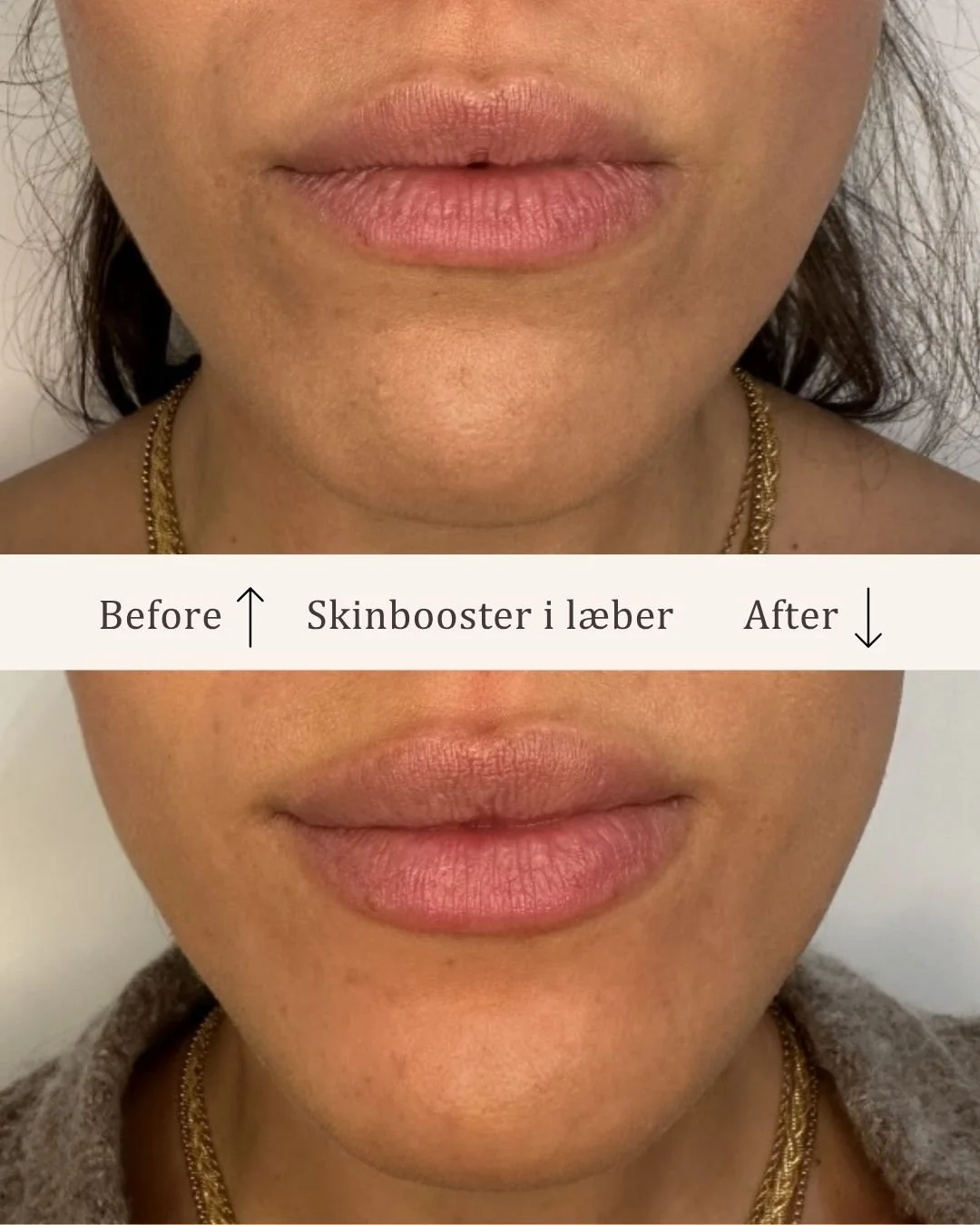 Skinbooster-læber-visage-studio-kosmetisk-klinik-odense.jpg