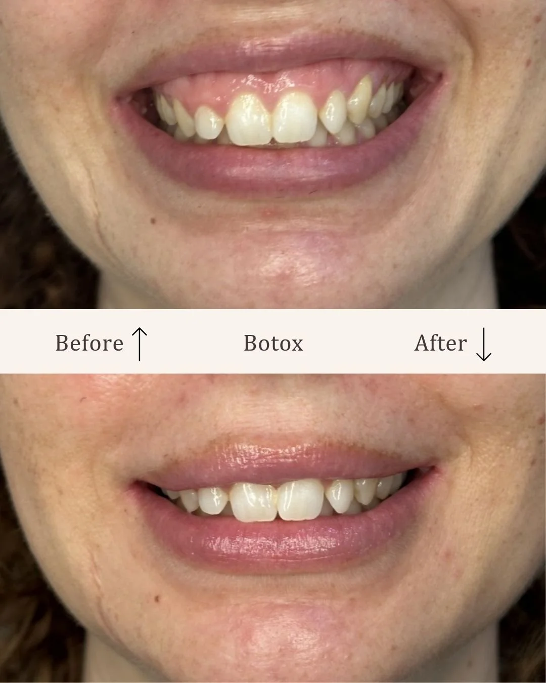 Botox-gummysmile-visage-studio-kosmetisk-klinik-odense-4.jpg