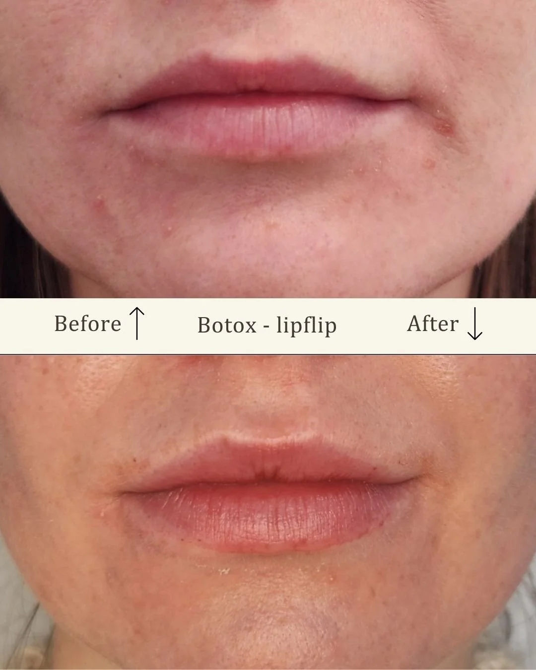 Før- og efterbillede af lip flip med Botox hos Visage Studio i Odense C