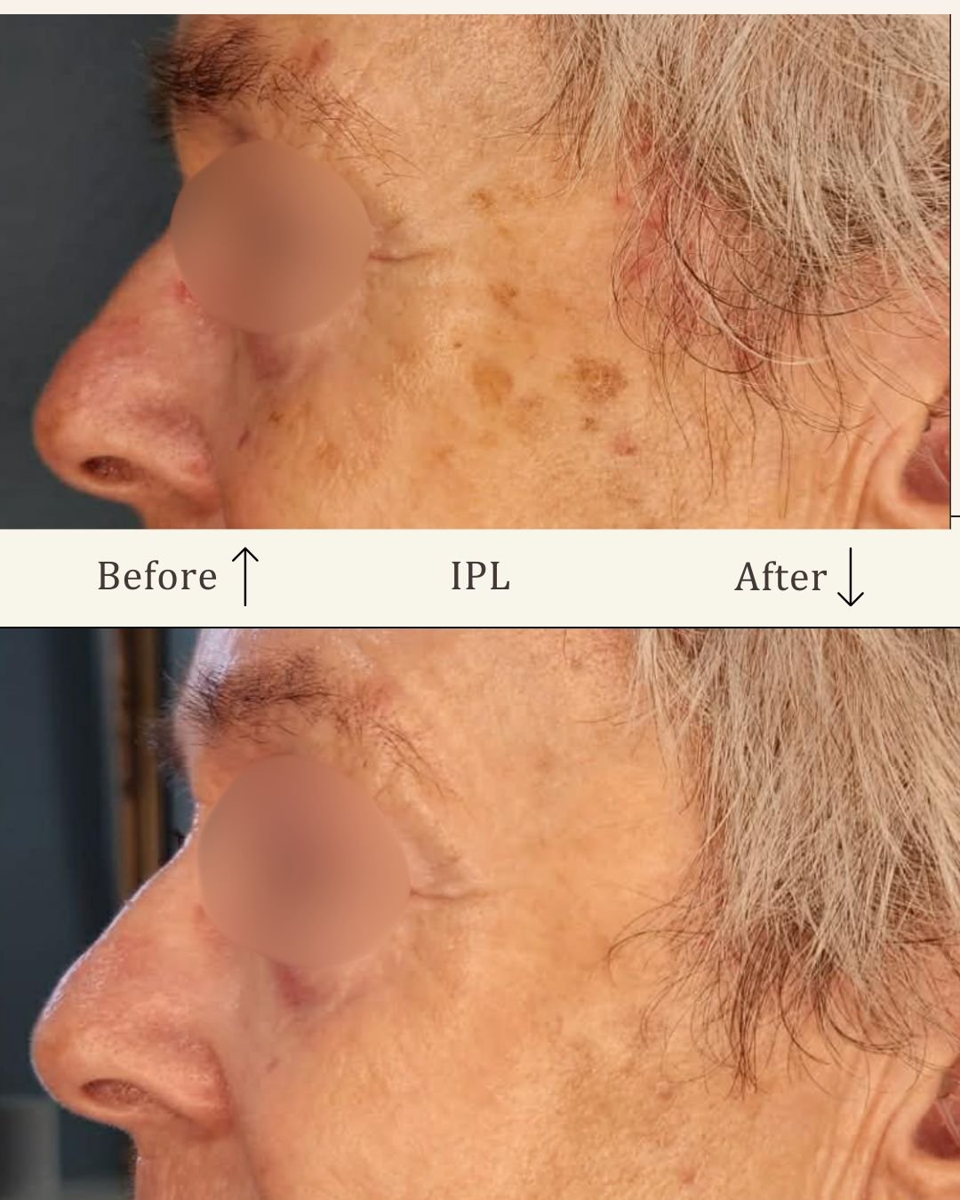 IPL-hudforyngende-ansigt-odense-for-efter-visage-studio.jpg