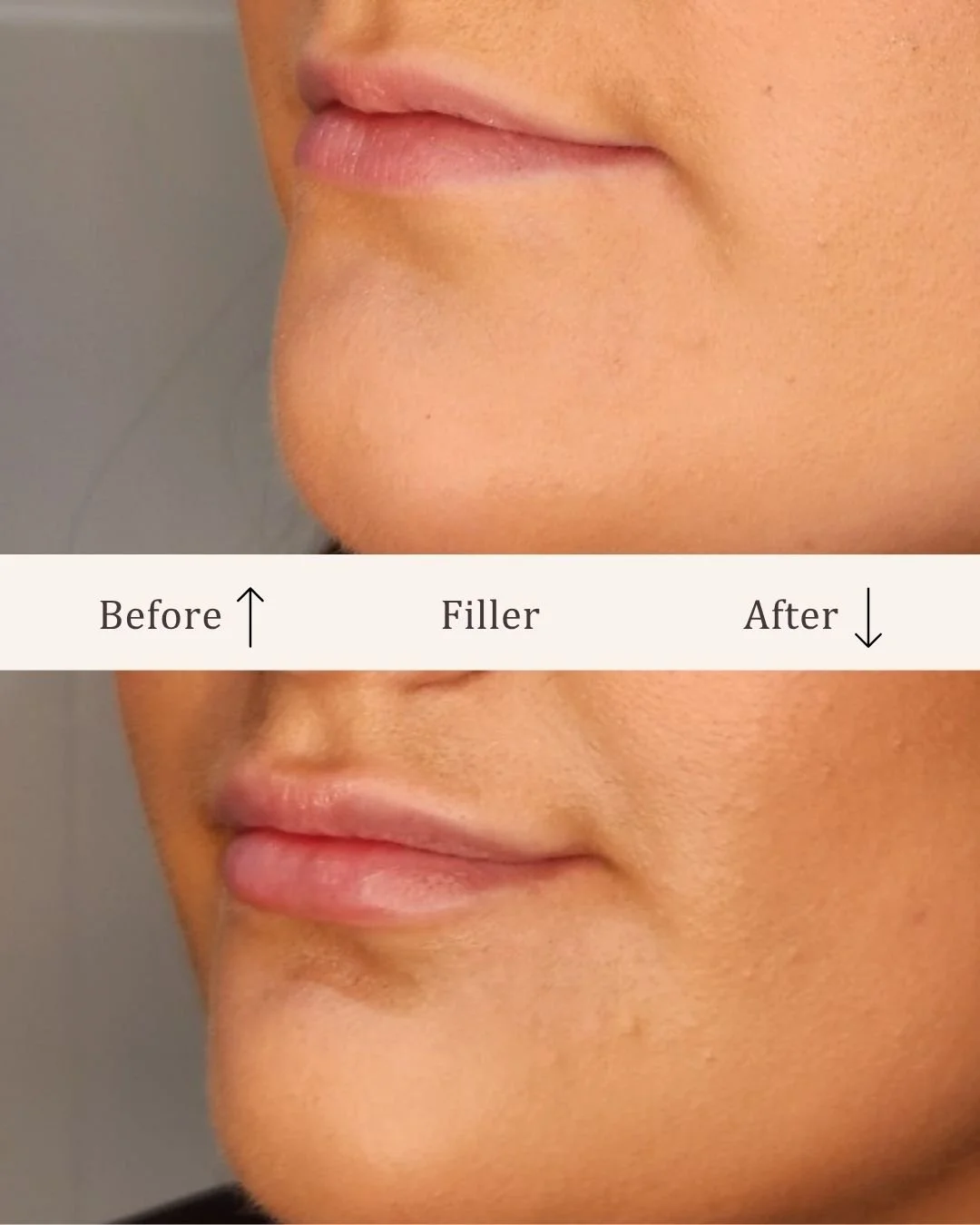 Filler-lipfiller-visage-studio-kosmetisk-klinik-odense-16.jpg
