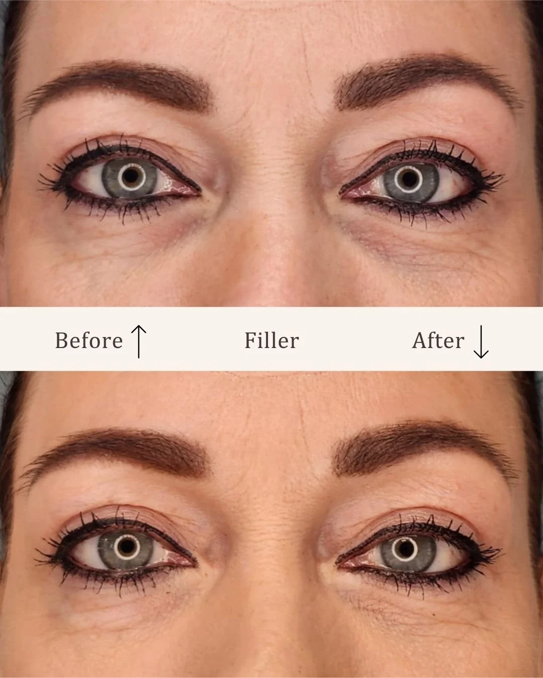 Filler-tear-trough-visage-studio-kosmetisk-klinik-odense-3.jpg