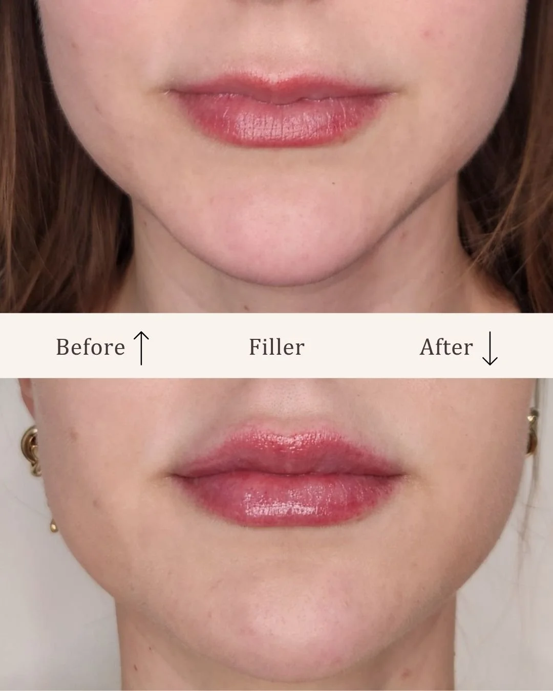 Filler-lipfiller-visage-studio-kosmetisk-klinik-odense-18.jpg