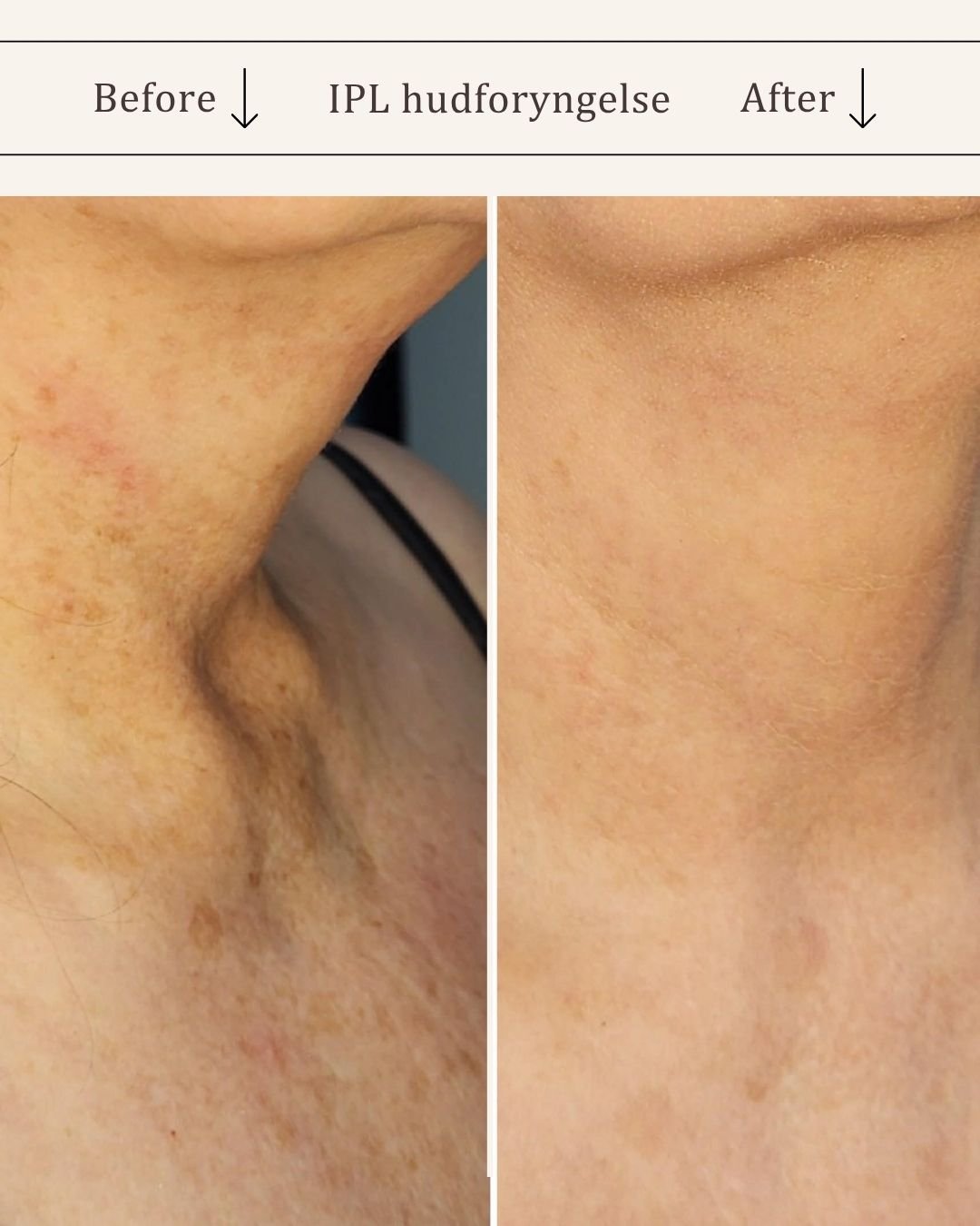 IPL-hud-foryngende-visage-studio-kosmetisk-klinik-odense-4.jpg