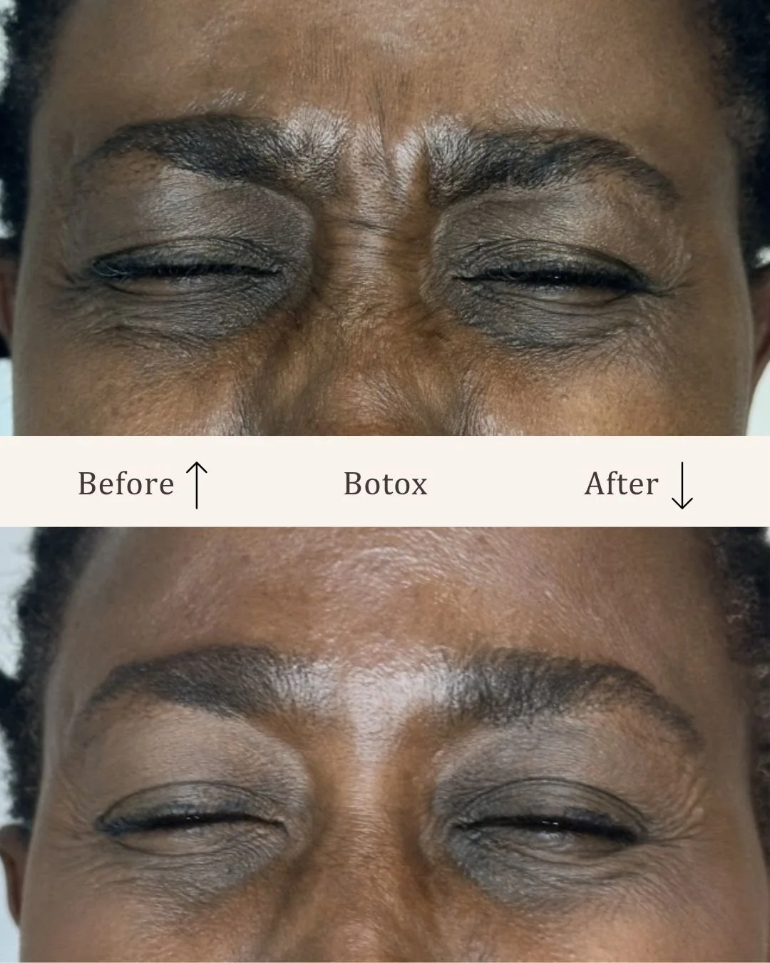 Botox-glabella-visage-studio-kosmetisk-klinik-odense-5.jpg