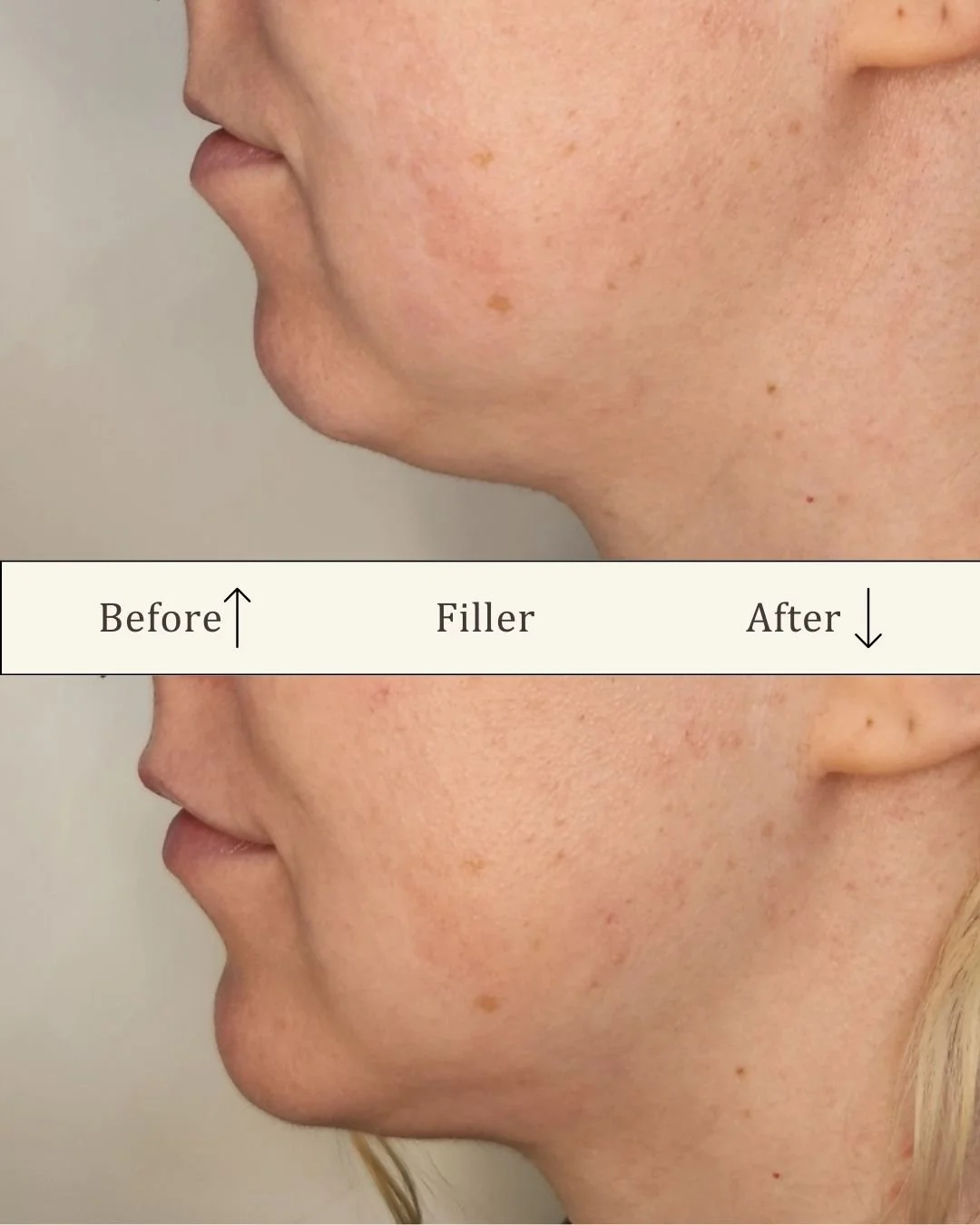 Filler i hage og læber